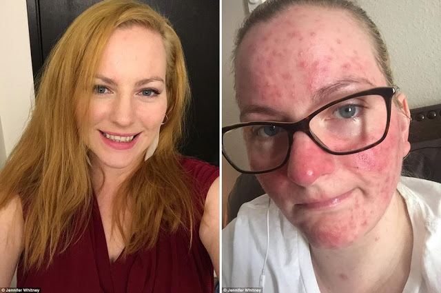 Mother Claims: Flu Shot Caused Blindness and Multiple Sclerosis After Being Forced to Vaccinate by Her Boss