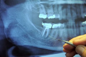 Shocking Connection: 97% of all Terminal Cancer Patients Previously Had This Dental Procedure...